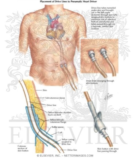 Watermarked preview of labeled image: Emergence of the Tubes to the Pneumatic Heart Driver