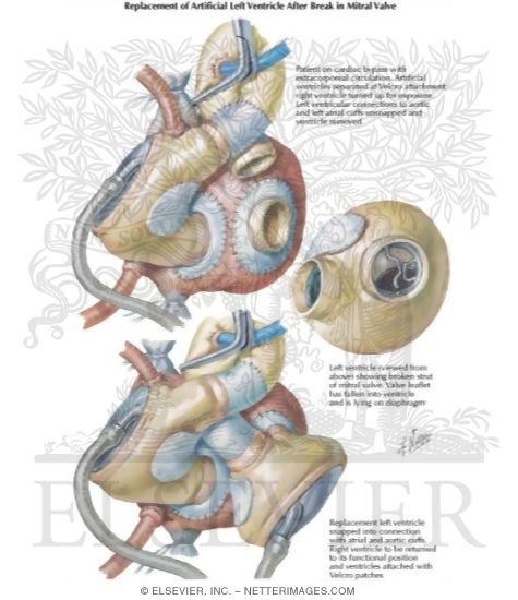 Watermarked preview of labeled image: Replacement of Artificial Left Ventricle Because of Break in its Av Valve