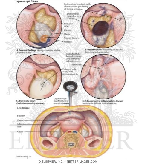 Watermarked preview of labeled image: Laparoscopic Views