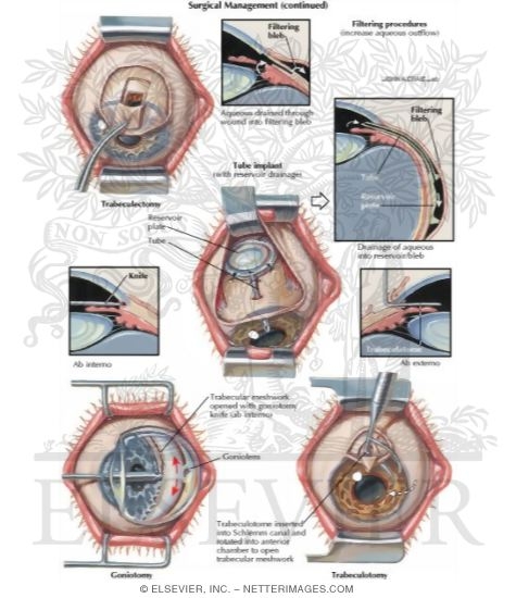 Watermarked preview of labeled image: Surgical Management