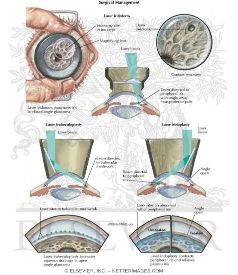 Watermarked preview of labeled image: Laser Techniques In Management of Glaucoma
