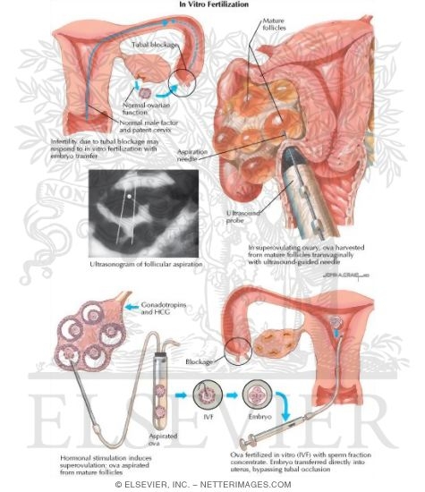 Watermarked preview of labeled image: In Vitro Fertilization