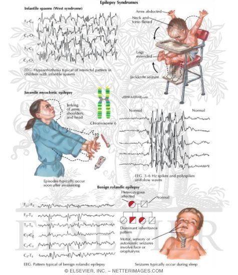 Epilepsy Syndromes