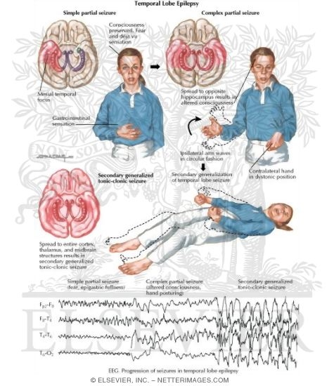 Temporal Lobe Epilepsy