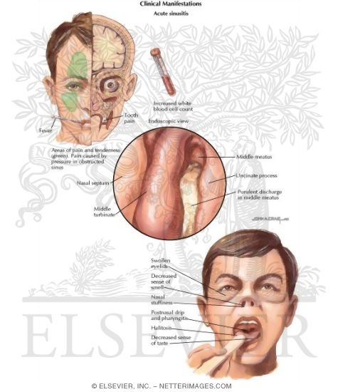 Sinusitis