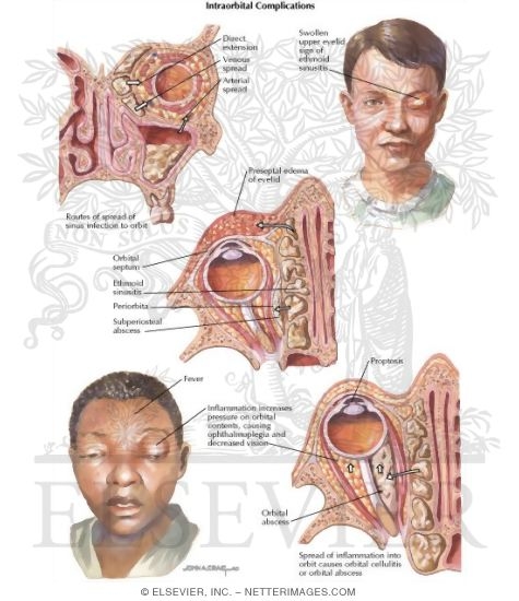 Orbital Spread of Sinus Infection