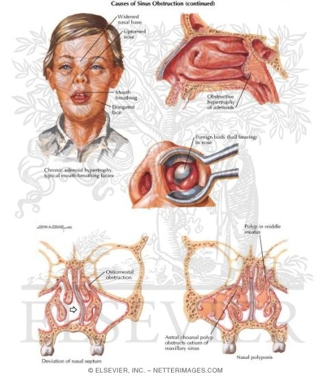 Watermarked preview of labeled image: Causes of Sinus Obstruction