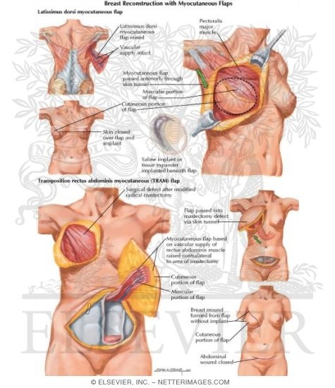 Watermarked preview of labeled image: Breast Reconstruction with Myocutaneous Flaps