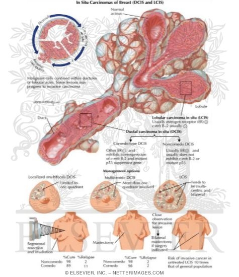 In Situ Carcinomas of Breast (DCIS and LCIS)