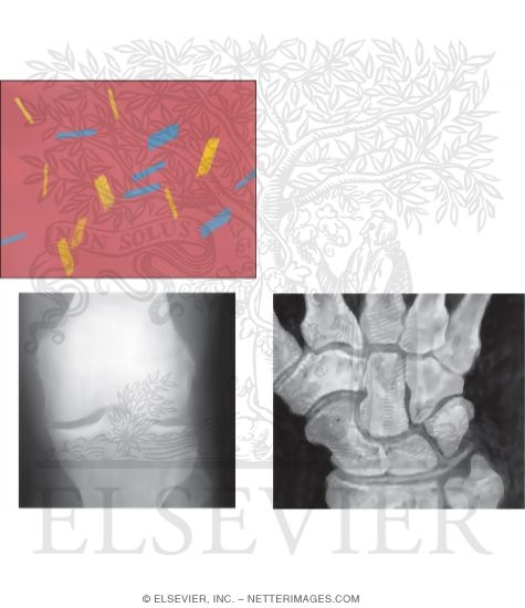 Watermarked preview of unlabeled image: Calcium Prophosphate Dihydrate Crystal Deposition Disease