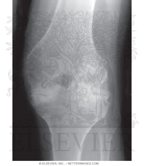 Watermarked preview of unlabeled image: Hemophilic Arthritis