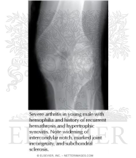 Watermarked preview of labeled image: Hemophilic Arthritis