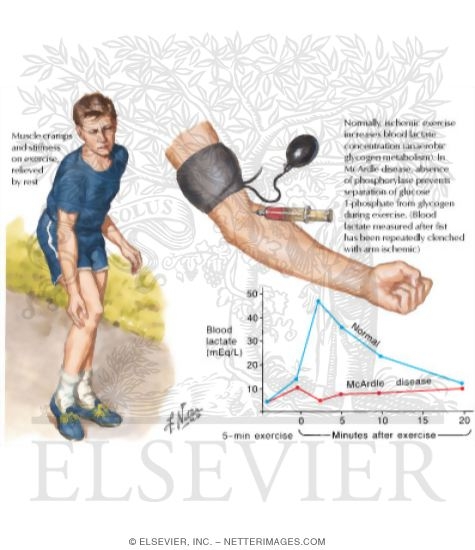 McArdle Disease