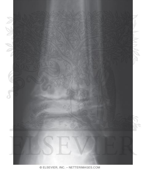 Watermarked preview of unlabeled image: Radiographic Changes In Healing Phyase of Late Acute Hematogenous Osteomyeltis