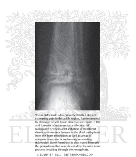 Watermarked preview of labeled image: Radiographic Changes In Healing Phyase of Late Acute Hematogenous Osteomyeltis