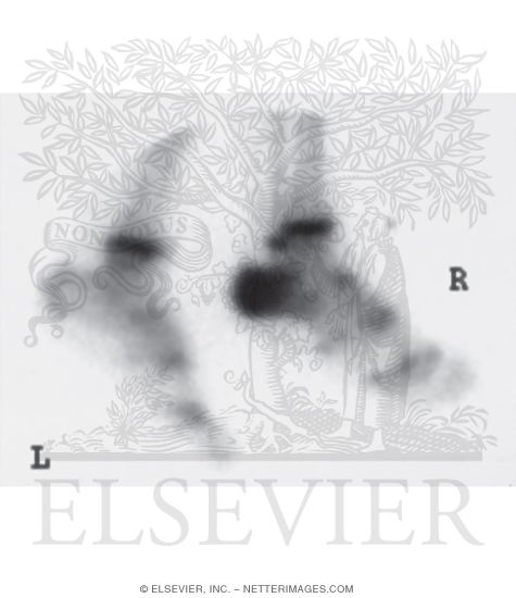 Watermarked preview of unlabeled image: Bone Scan In Acute Osteomyelitis