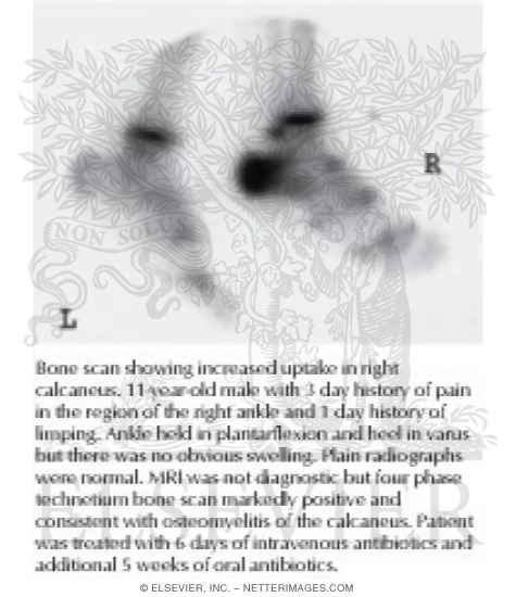 Bone Scan In Acute Osteomyelitis