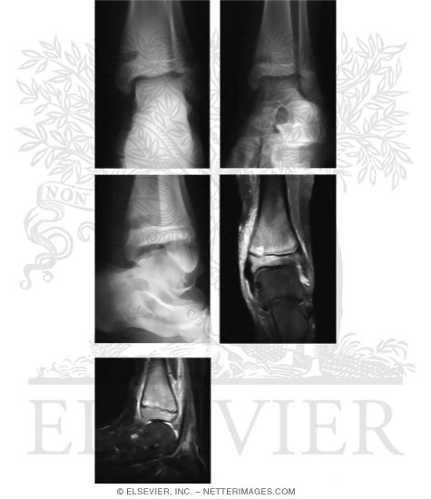 Watermarked preview of unlabeled image: Subacute Osteomyelitis