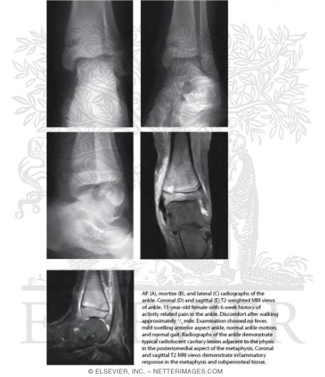 Watermarked preview of labeled image: Subacute Osteomyelitis