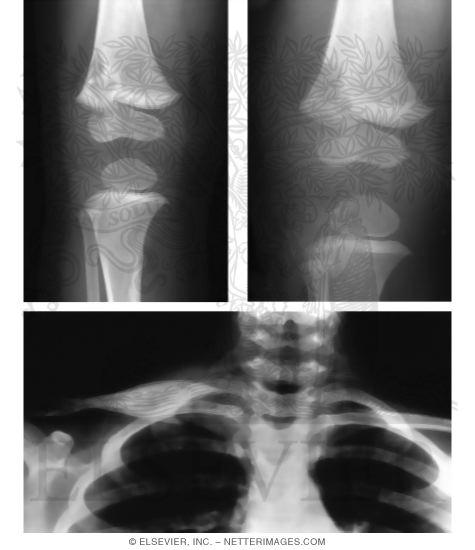 Subacute Osteomyelitis