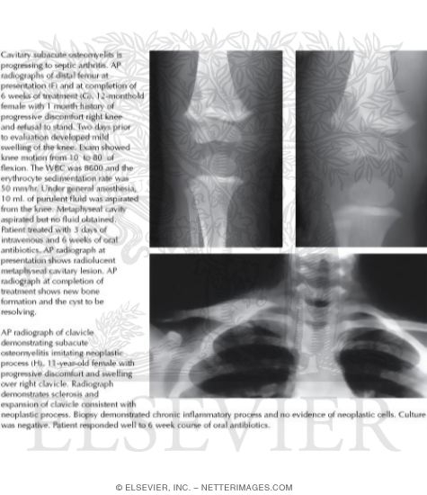 Watermarked preview of labeled image: Subacute Osteomyelitis