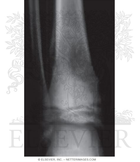 Watermarked preview of unlabeled image: Bone Destruction In Osteosarcoma