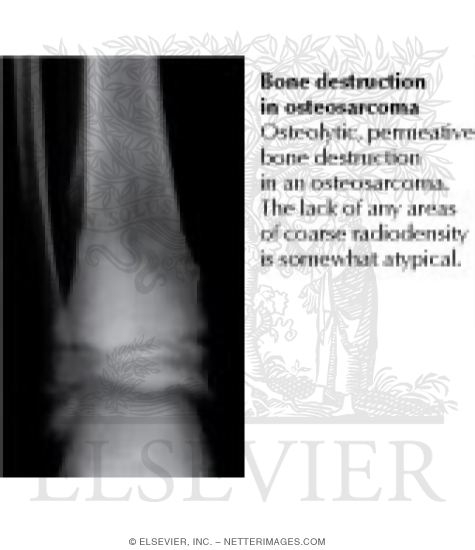 Watermarked preview of labeled image: Bone Destruction In Osteosarcoma