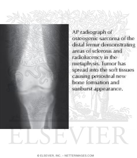 Watermarked preview of labeled image: Neoplasms In Bone