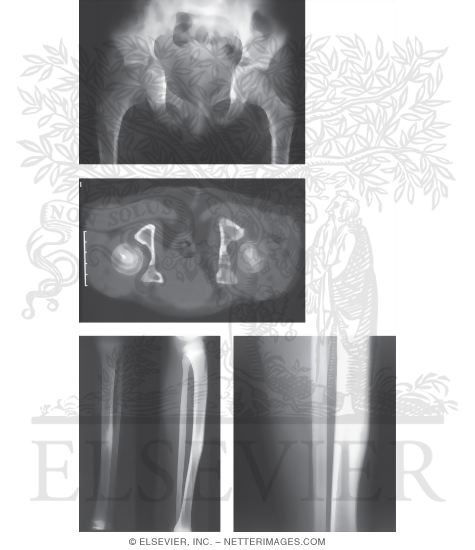 Watermarked preview of unlabeled image: Osteoid Osteoma