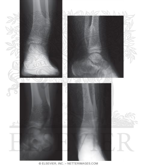 Solitary Osteochondroma