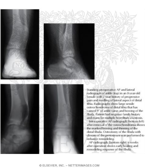 Watermarked preview of labeled image: Solitary Osteochondroma