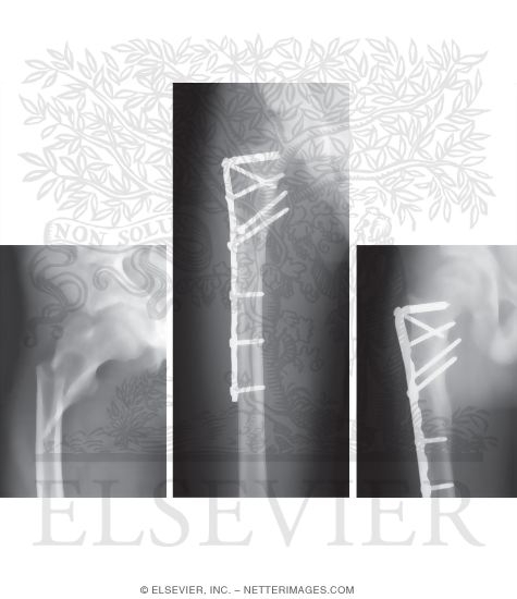 Watermarked preview of unlabeled image: Pathologic Fracture Through Solitary Bone Cyst