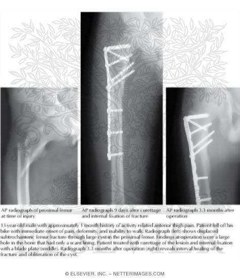 Watermarked preview of labeled image: Pathologic Fracture Through Solitary Bone Cyst