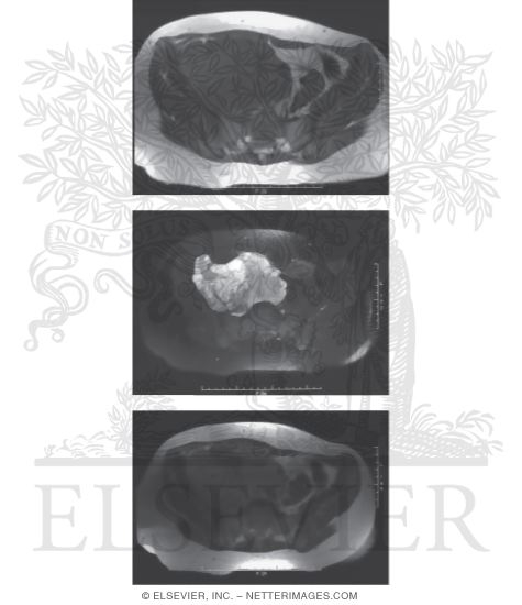 Watermarked preview of unlabeled image: Ewing's Sarcoma