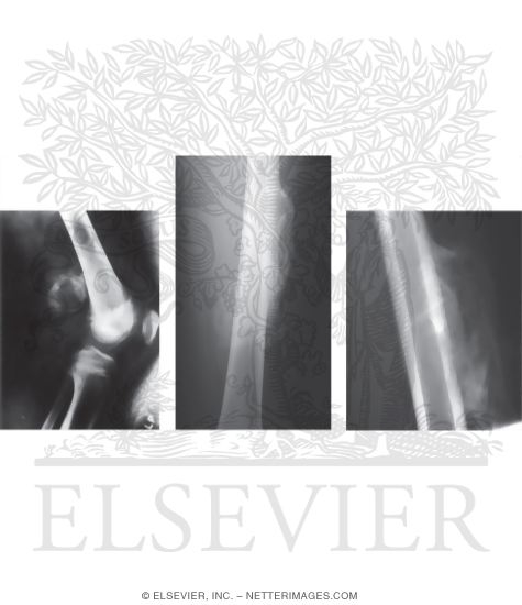 Myositis Ossificans