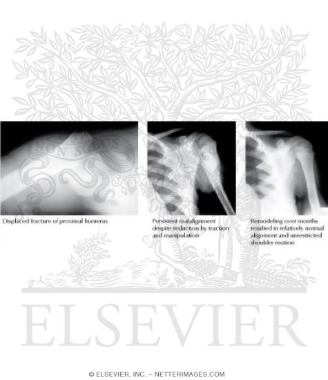 Watermarked preview of labeled image: Remodeling of Fracture of Proximal Humerus In a Child