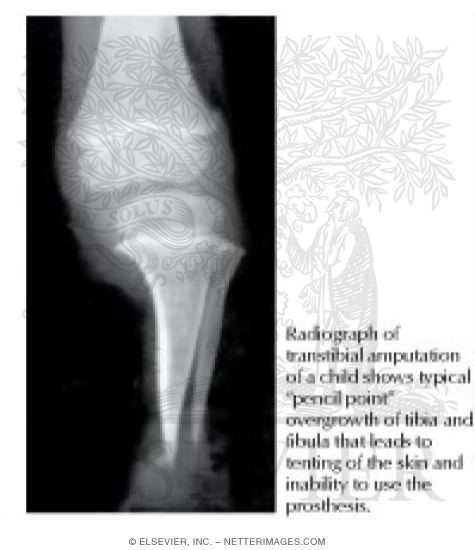 Bony Overgrowth