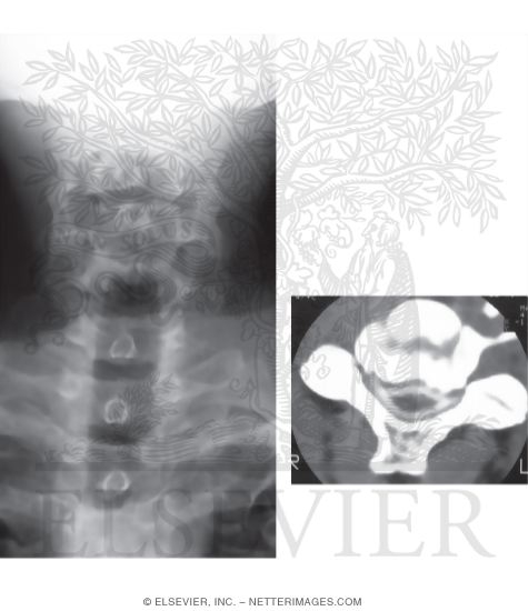 Watermarked preview of unlabeled image: Cervical Spondylosis With Myelopathy