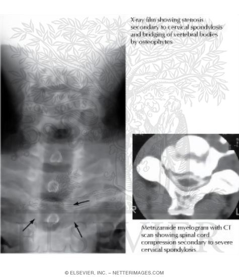 Watermarked preview of labeled image: Cervical Spondylosis With Myelopathy