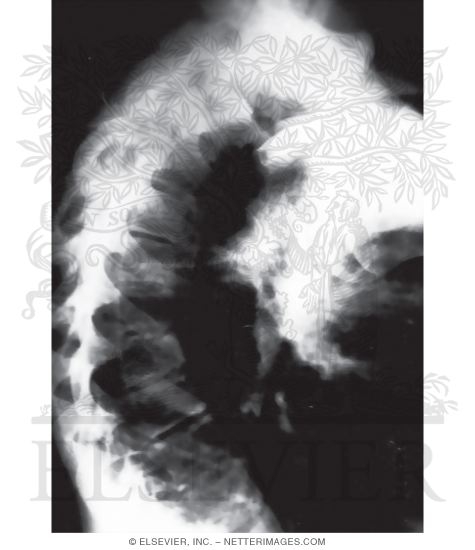 Watermarked preview of unlabeled image: Scheuermann Disease