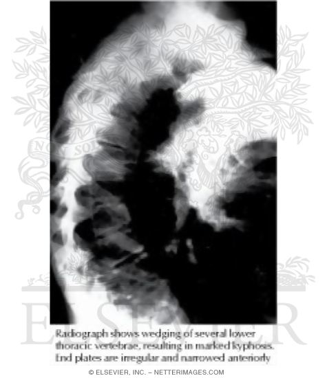Watermarked preview of labeled image: Scheuermann Disease