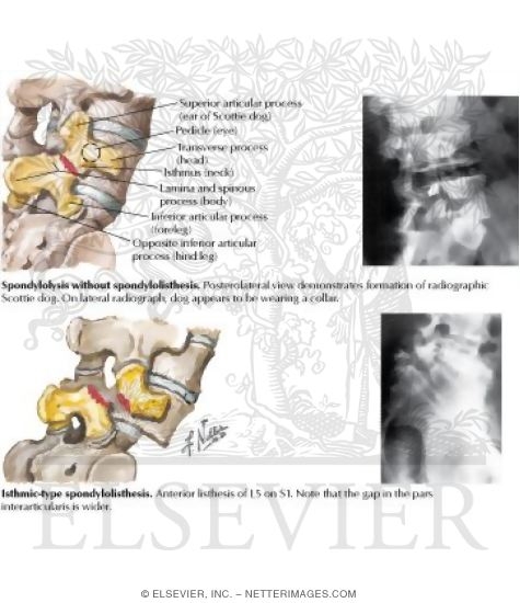 Spondylolysis and Spondylolisthesis
