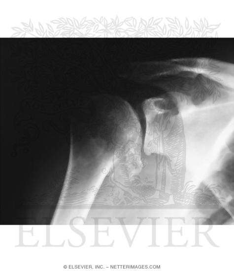 Watermarked preview of unlabeled image: Osteoarthritis of the Shoulder