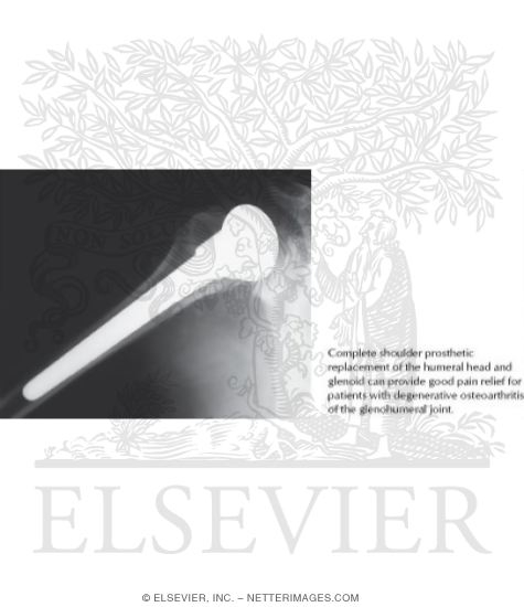 Prosthetic Replacement of Shoulder Joint