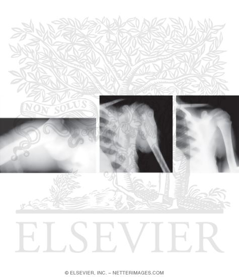 Watermarked preview of unlabeled image: Fracture of Proximal Humerus In Children