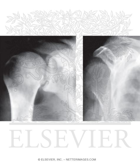 Watermarked preview of unlabeled image: Posterior Dislocation, Glenohumeral Joint