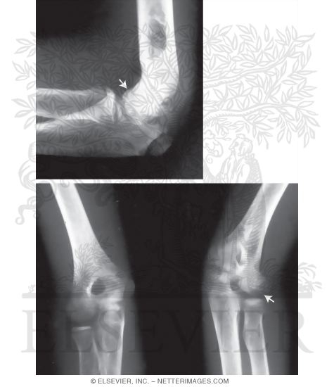 Osteochondrosis of the Capitellum