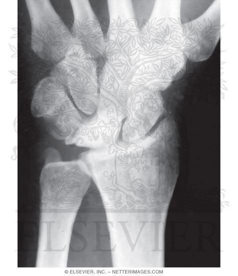 Watermarked preview of unlabeled image: Radiograph In Kienb&ouml;ck Disease