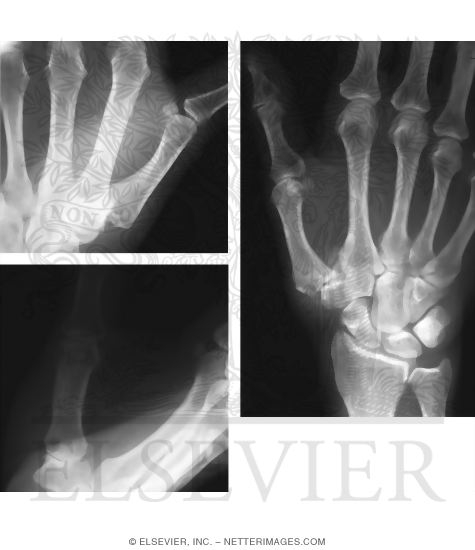 Watermarked preview of unlabeled image: Osteoarthritis of Thumb Carpometacarpal Joint