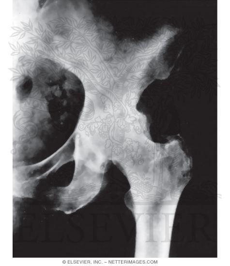 Watermarked preview of unlabeled image: Osteoarthritis of the Hip